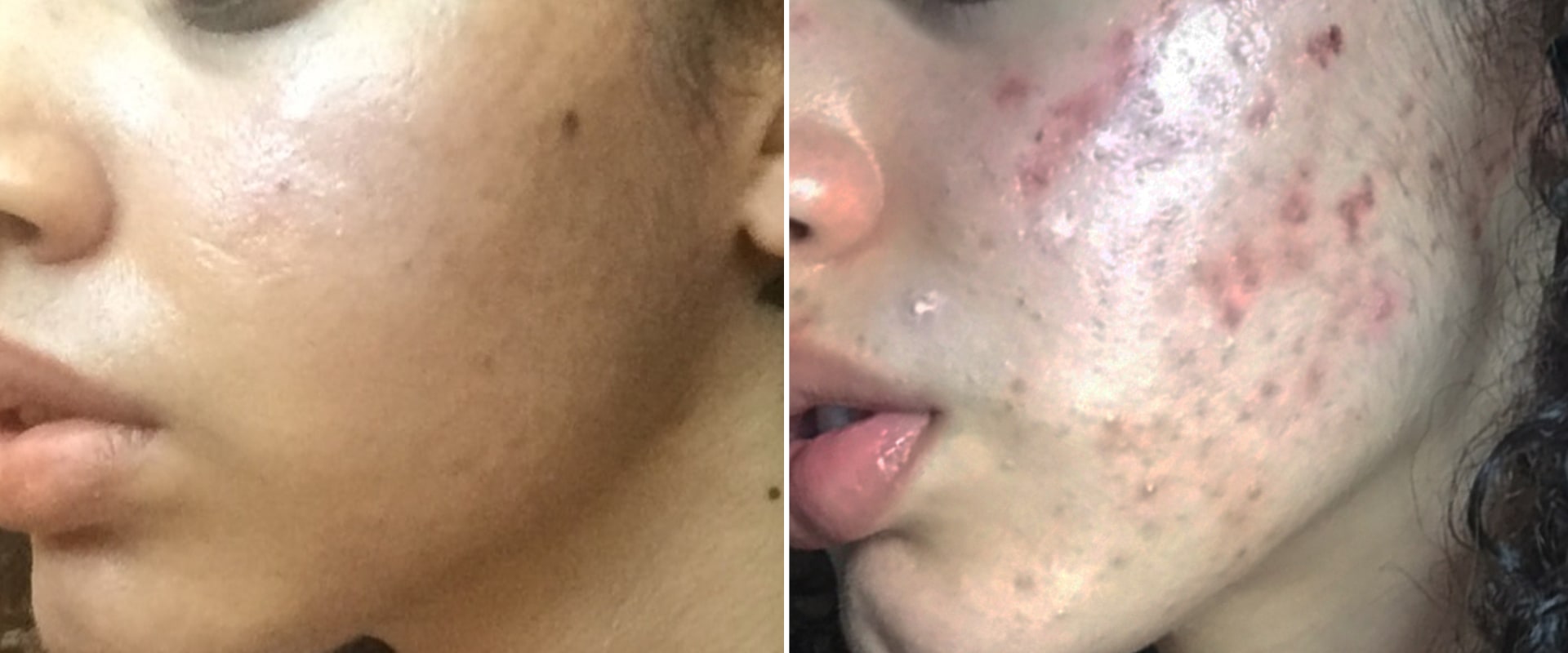 What is the best skincare for acne?