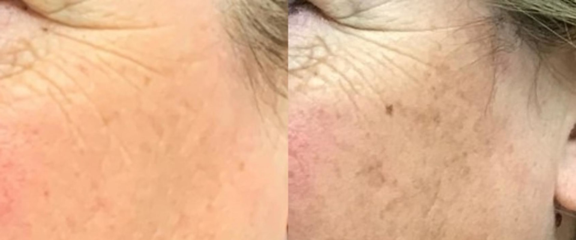 Can dark spots really be removed?