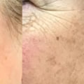 Can dark spots really be removed?