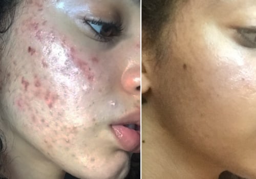 What is the best skincare for acne?