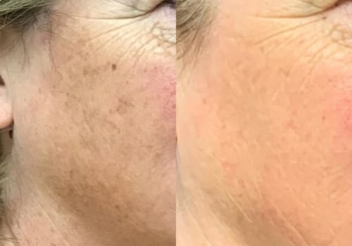 Can dark spots really be removed?